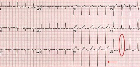 hypertrophy of lv|qrs widening and repolarization abnormality.